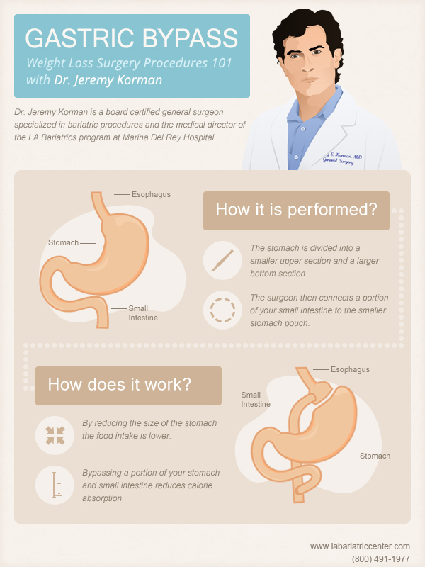 Gastric Bypass With Dr. Jeremy Korman